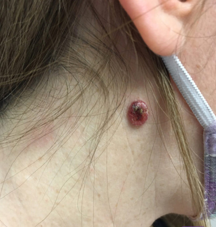 Deborah's Melanoma photo