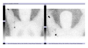 Lymphoscintigram of a patient with a primary melanoma of the forearm, with intense uptake of radioactive colloid in an epitrochlear node and uptake of the tracer in axillary region.