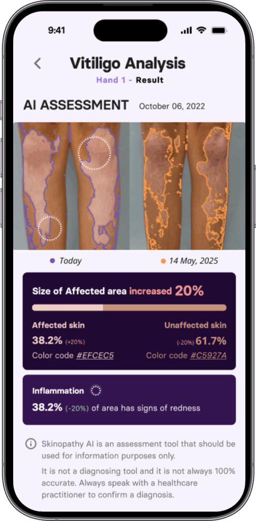 Skinopathy vitiligo app Ai assessment - comparison