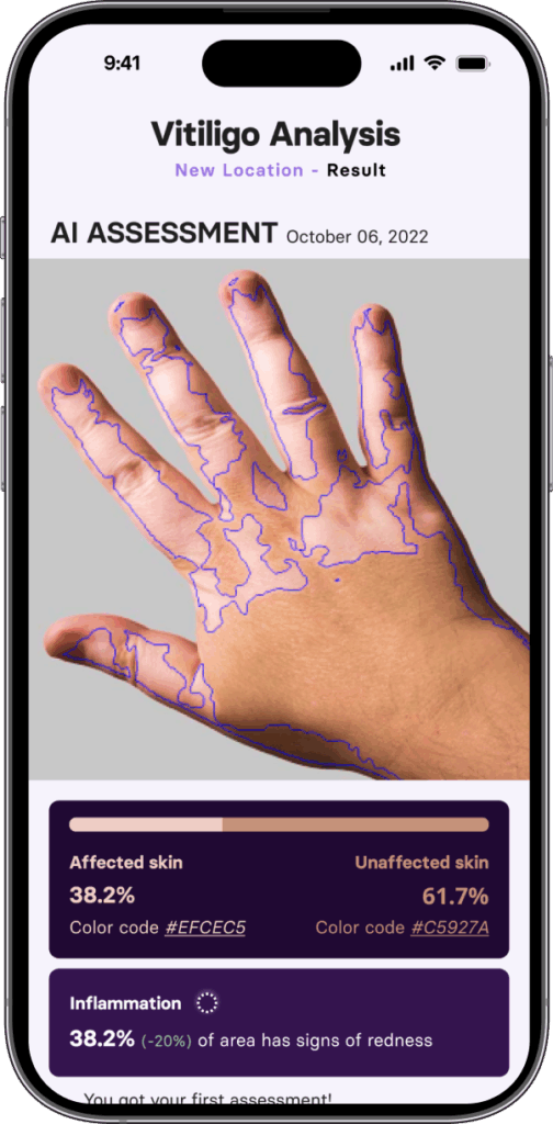 Skinopathy vitiligo app Ai assessment