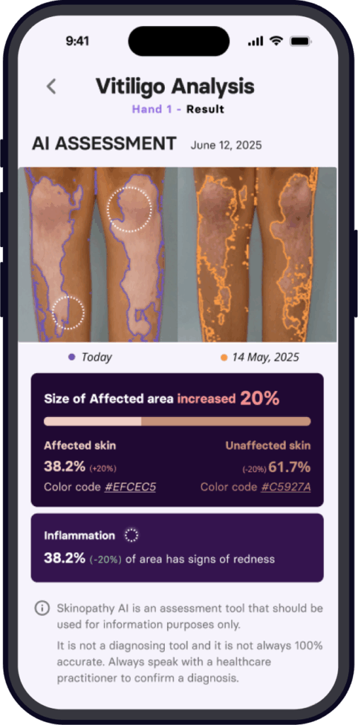 Skinopathy Vitiligo App tracking