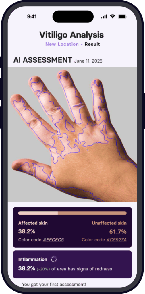 Skinopathy Vitiligo App results